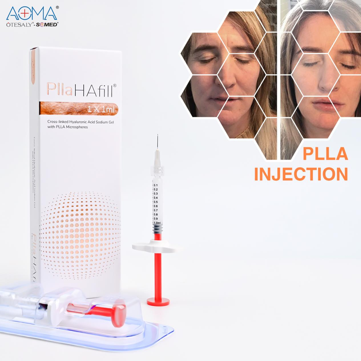 Sculptra PLLA 填充剂：有效面部轮廓的关键