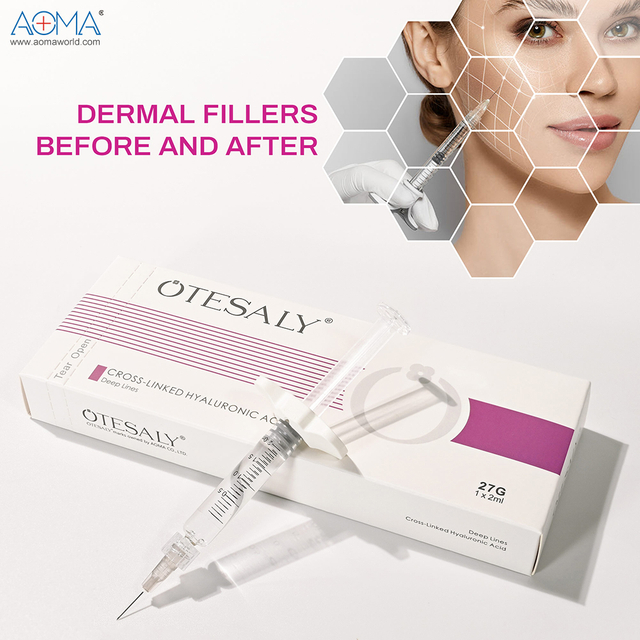 CE Naaprobaran nga nauneg nga linya 2ml facial filler chin cheek augmentation .
