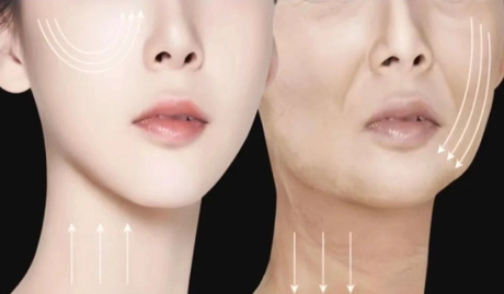 Midface Contour Restoration_ Thuto ya mohlala ya kliniki ka ga phošollo ya go oketša marama ka ditlatša tša HA.jpg .